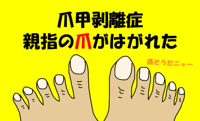 親指の爪が「爪甲出血」から「爪甲剥離症」に。サッカー、野球、マラソン選手は爪がはがれてしまうことがあります。