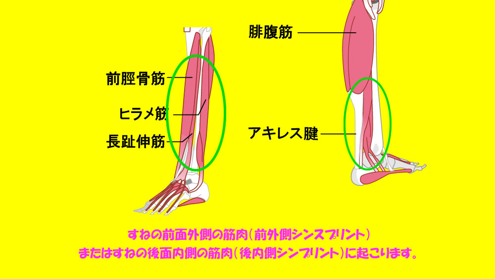 シンスプリントは、脛の前面外側の筋肉、すねの前面外側の筋肉（前外側シンスプリント）または脛の後面内側の筋肉に痛みを感じる