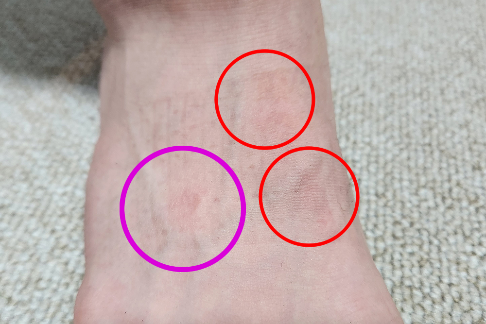 ジュニアユース　ケガ　スパイク　スタッド痕